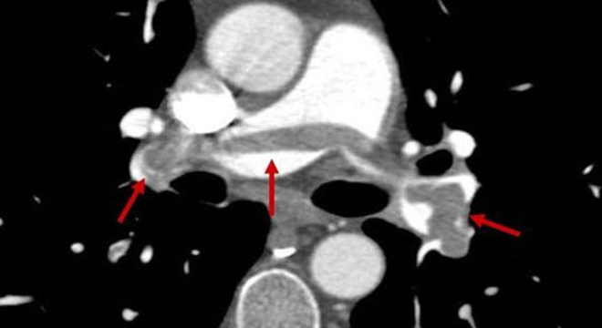 Beinvenenthrombosen: Verschiedene Untersuchungsmöglichkeiten