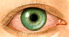 Bindehautentzündung: Rotes Auge und Jucken