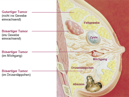 Brustdrüse Tumorarten