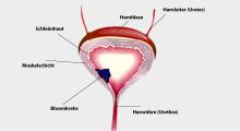 Blasenkrebs: Bösartige Tumore in der Blase