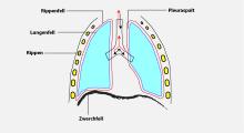 Brustfellentzündung: meist die schmerzhafte Folge einer Atemwegserkrankung