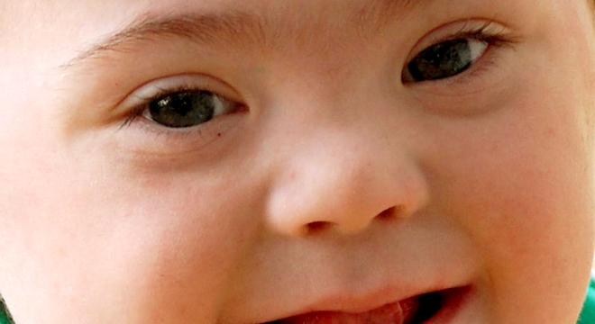 Down-Syndrom: Körperliche- und Entwicklungsdefizite