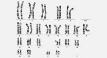 Down-Syndrom: Chromosomendefekt