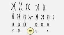 Down-Syndrom: Trisomie 21, zahlenmässige Chormosomenanomalie