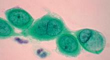 Chlamydien-Infektion: Chlamydia trachomatis