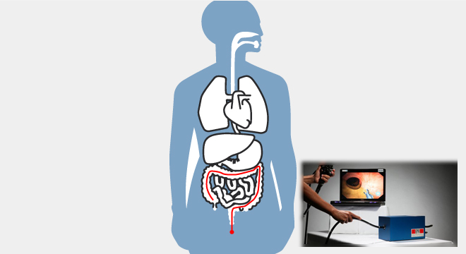 Gastrointestinale Stromatumore: Darmspiegelung, Magenspiegelung