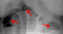 Darmverschluss: Abhören, Abtasten, Röntgenaufnahmen