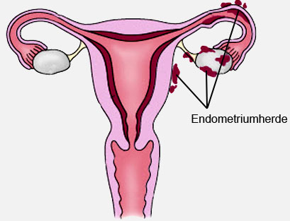 Endometriosen-Herde