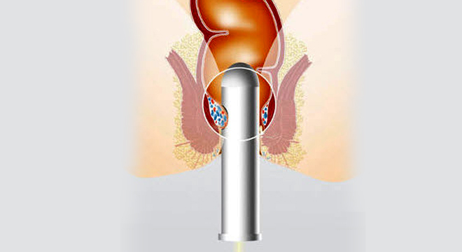 Hämorrhoiden: Enddarmuntersuchung