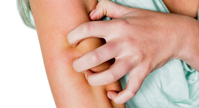 Krätze: stark juckende Hautkrankheit