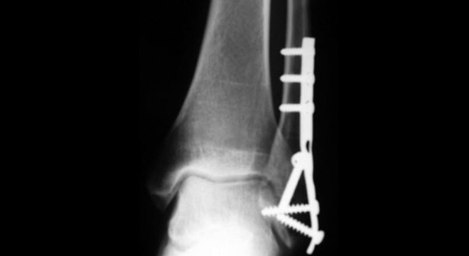 Knöchelbruch: operative Fixation und Stabilisation