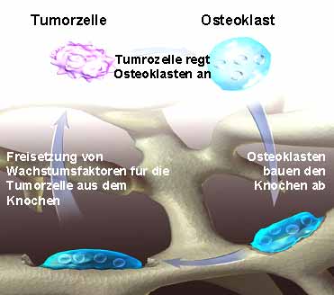 Knochenabbau