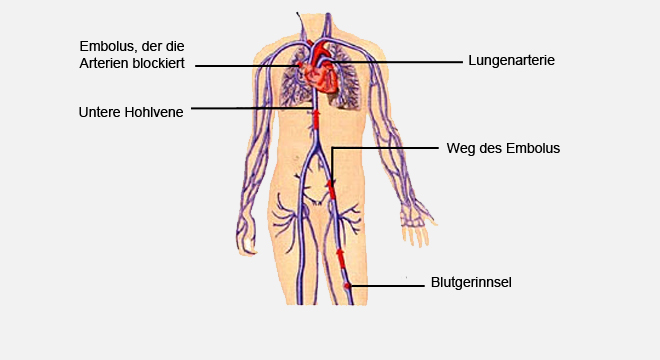 Beinvenenthrombosen: Blutgerinnsel im Blutgefässsystem