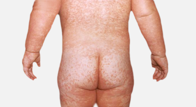 Masern: eine akute ansteckende Virus-Infektionserkrankung
