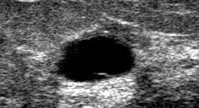 Mastopathie: Ultraschall einer weiblichen Brust