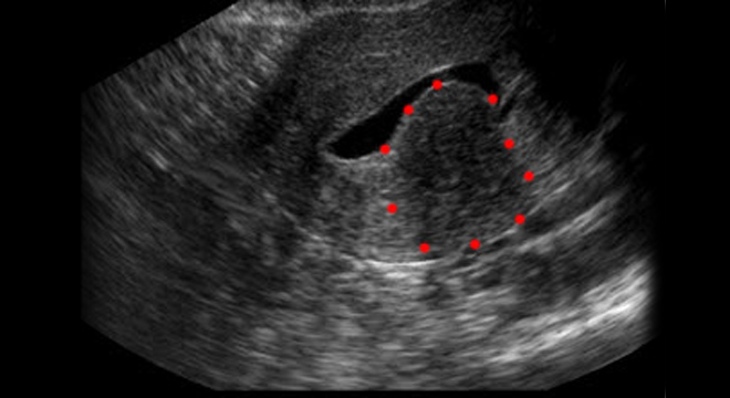 Myom der Gebärmutter: Ultraschalluntersuchung