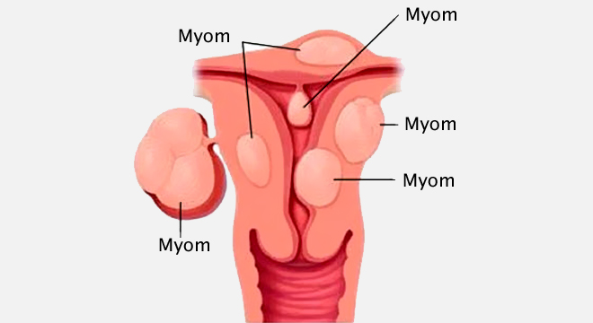 Myom der Gebärmutter: guartige Geschwulste