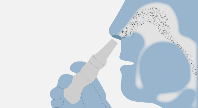 Nasenpolypen: Nasenspray bei kleinen Polypen sonst Operation