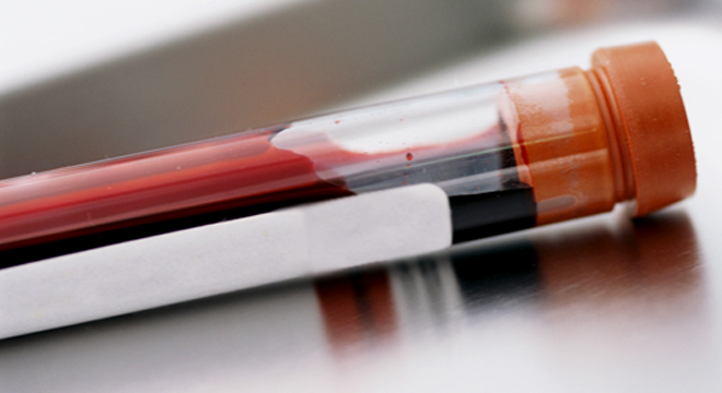 Nebenschilddrüsenüberfunktion: Hormonbestimmung im Blut