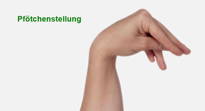Nebenschilddrüsenunterfunktion: Typischer Muskelkrampf (Tetanie)