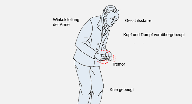 Parkinson: fortschreitende Erkrankung des Nervensystems
