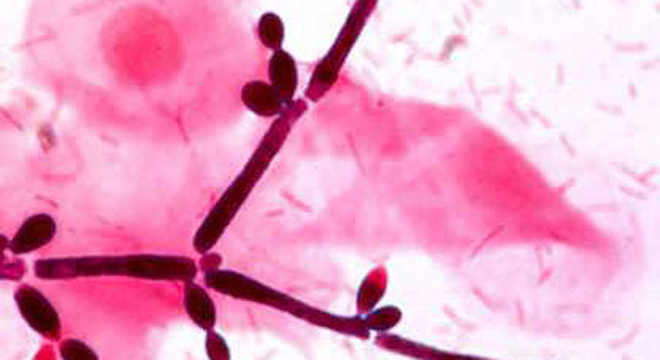 Pilzinfektionen: Untersuchung unter dem Mikroskop mit Spezialfärbung