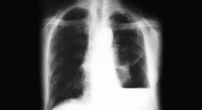 Pneumothorax: Röntgenbild des Brustkorbs