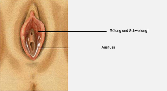 Schamlippe rote juckende Vulvovaginitis bei