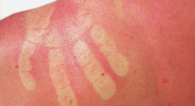 Sonnenbrand: Verbrennung der Haut durch UV-Strahlung.