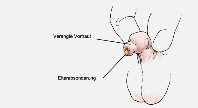 Vorhautverengung: Verklebung oder Vernarbung der männlichen Vorhaut.