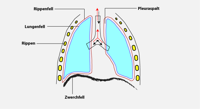 Brustfellentzündung, Rippenfellentzündung, Pleuritis
