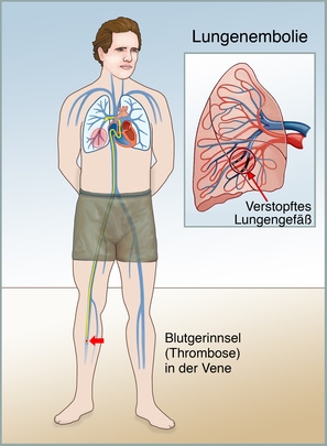 Embolie pulmonaire symptome